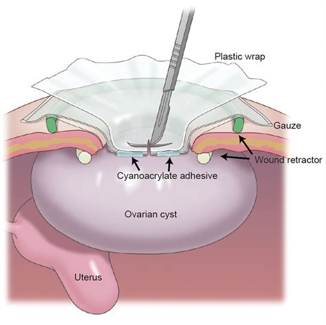biopsy of ovarian cyst procedure.